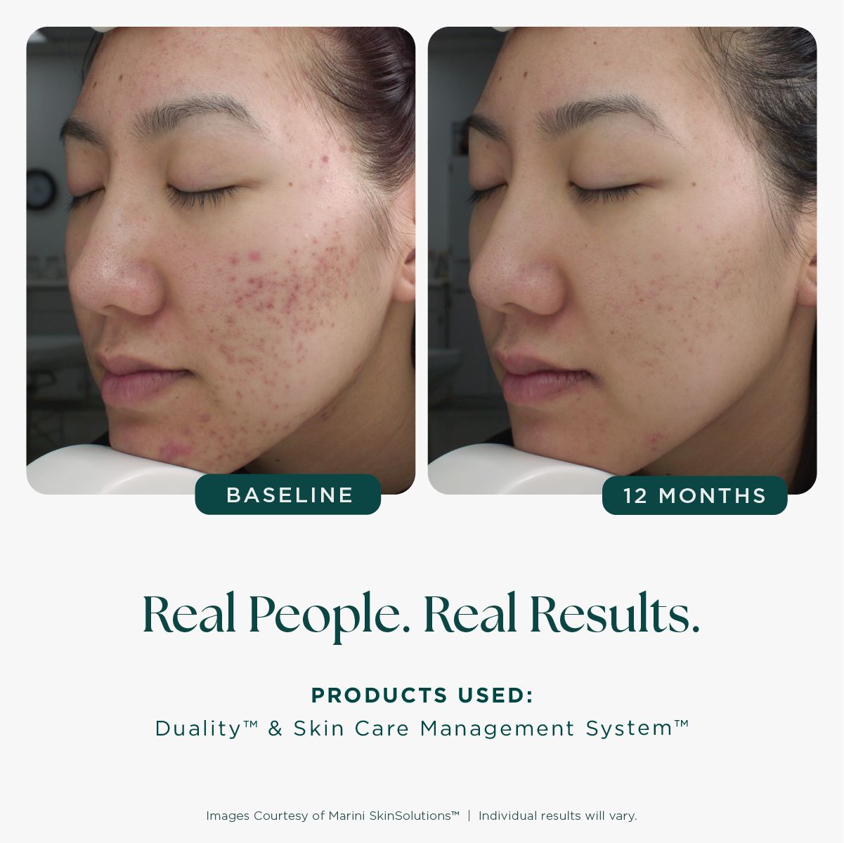 Marini Skinsolutions Age Intervention™ Duality™ Original or MD Strength