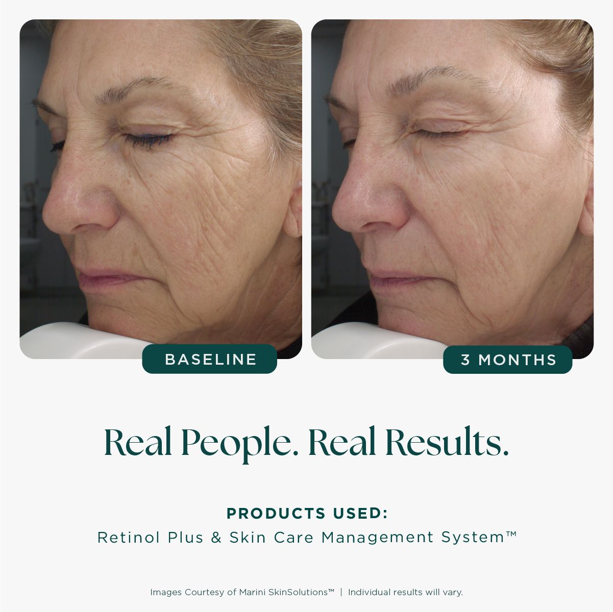 Marini Skinsolutions Age Intervention™ Retinol Plus/MD