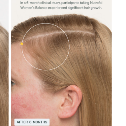 Before and after comparison of hair growth with Nutrafol Women's Balance product.